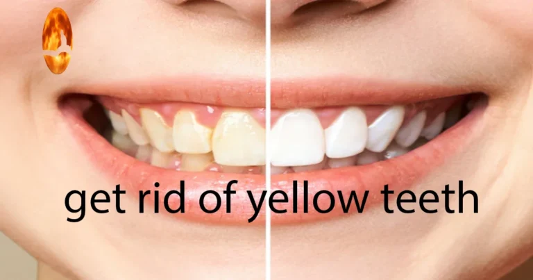 Yellow Teeth