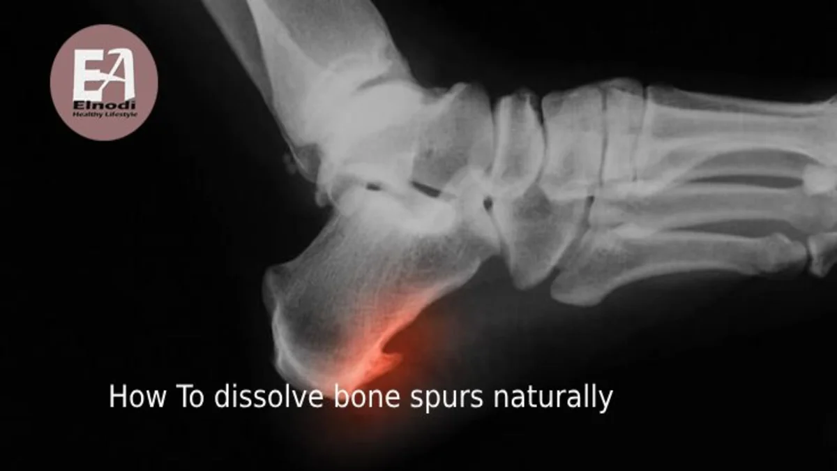 How to Dissolve Bone Spurs Naturally