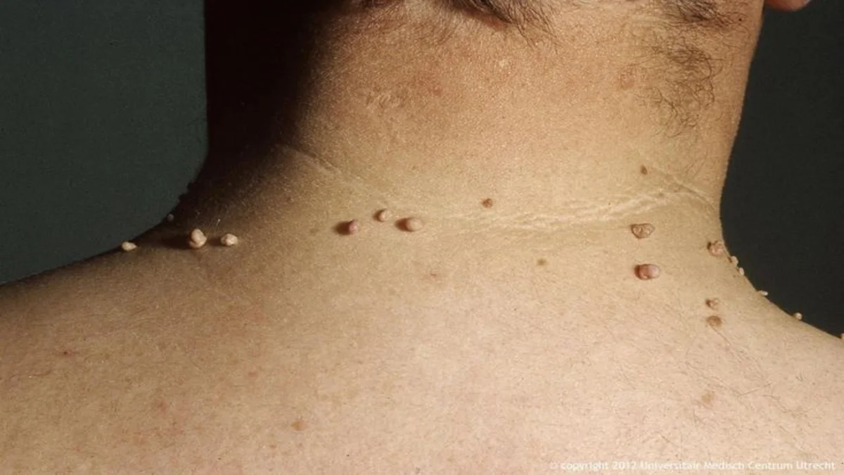 a close-up of a person's neck for remove skin tags